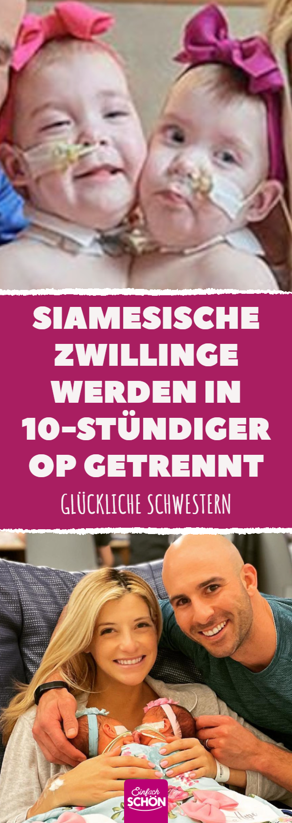 Siamesische Zwillinge werden in 10-stündiger OP getrennt